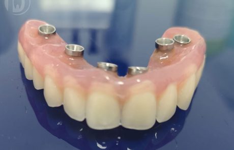 Fast & Fixed - Reabilitare orală totală într-o singură ședință