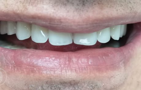 Fast & Fixed - Reabilitare orală totală într-o singură ședință(3)