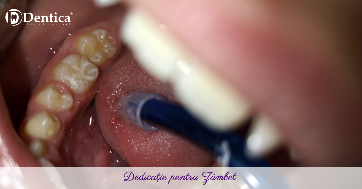 Sigilare dentară