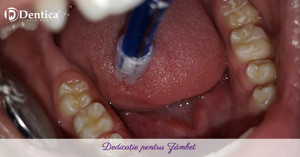 Sigilare dentară
